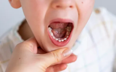 When Do Kids Start Losing Baby Teeth? A Timeline for Parents in Springdale